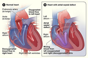 Atrial Septic Defect