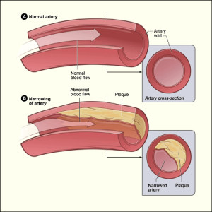 Effects of Coronary Arty Disease