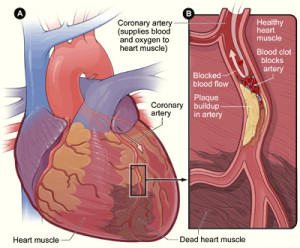Coronary Arty Disease can cause a heart attack