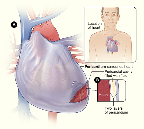 pericarditis