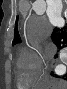 Angiogram