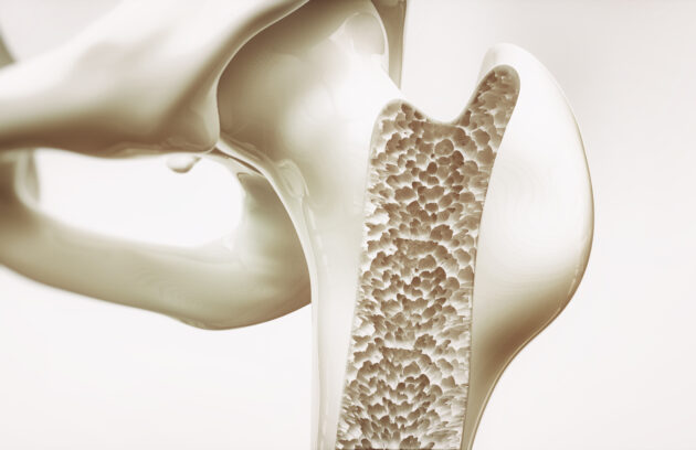 Osteoporosis: Understanding the Silent Bone Thief