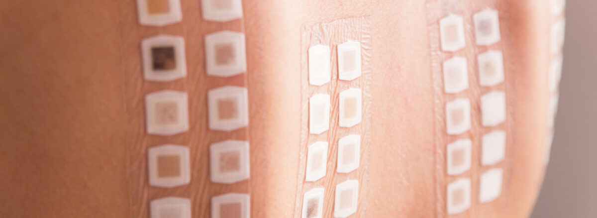 Understanding Patch Tests for Contact Dermatitis Diagnosis