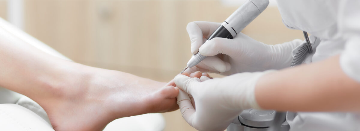 Debridement of Dead Skin