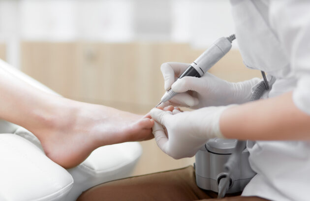 Debridement of Dead Skin
