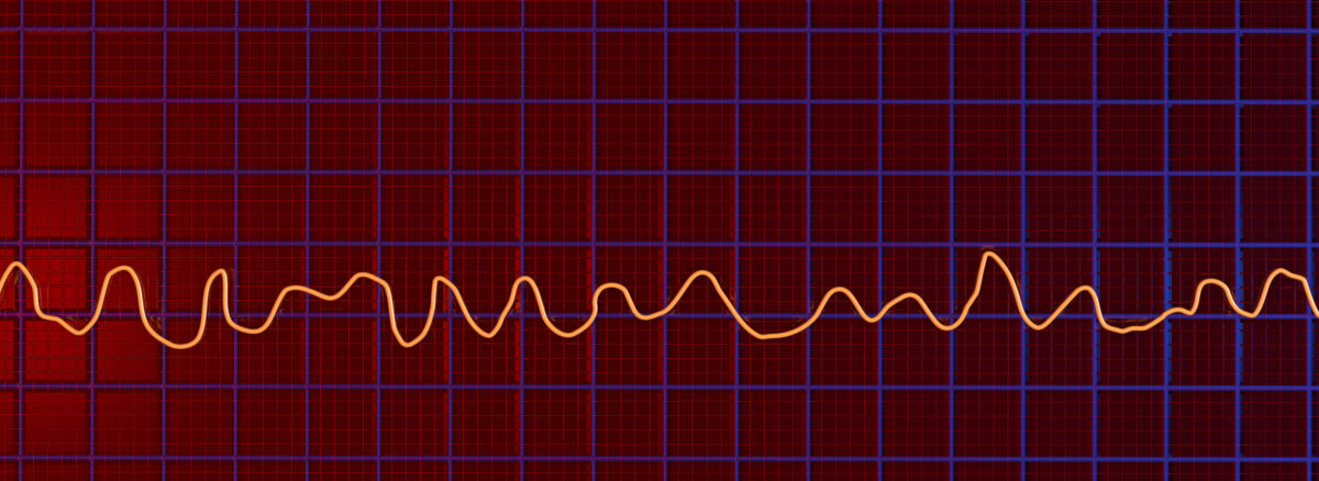 Ventricular Fibrillation: Understanding the Life-Threatening Cardiac Emergency