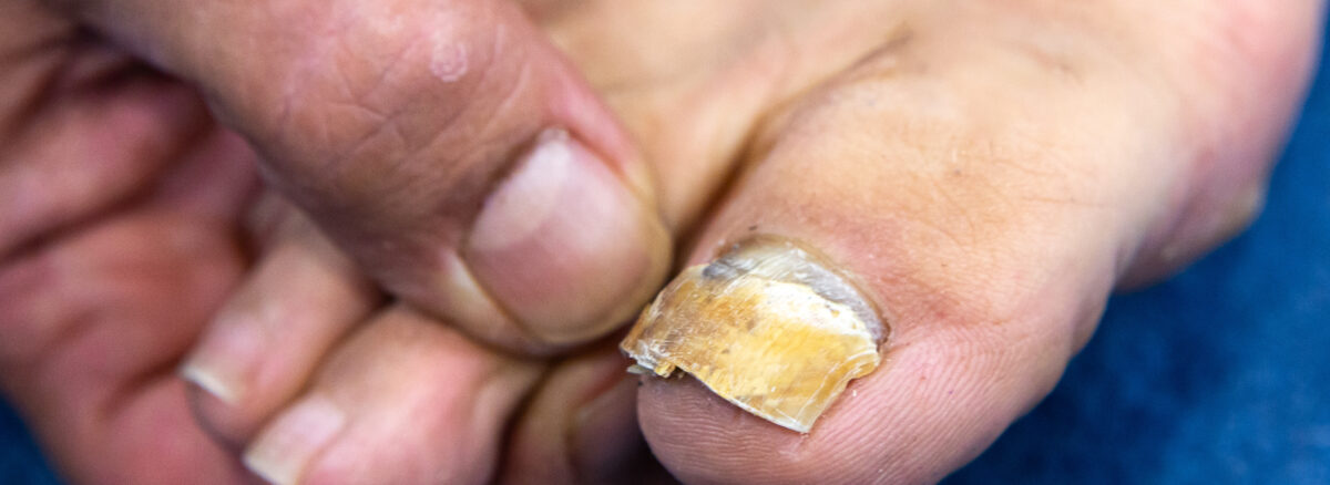Fungal Nail Infections