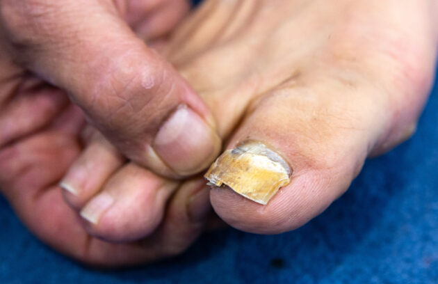 Fungal Nail Infections