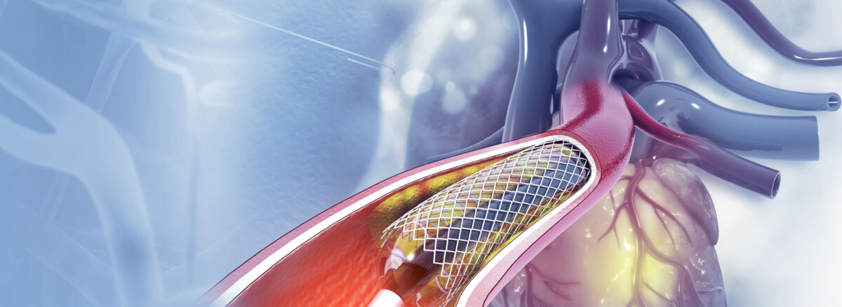 Angioplasty and Stenting