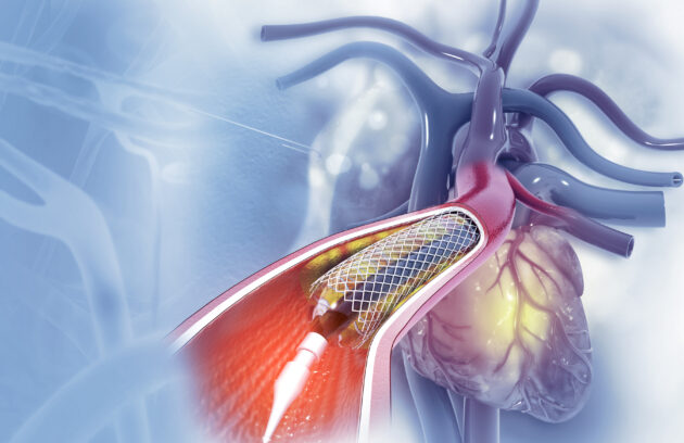 Angioplasty and Stenting