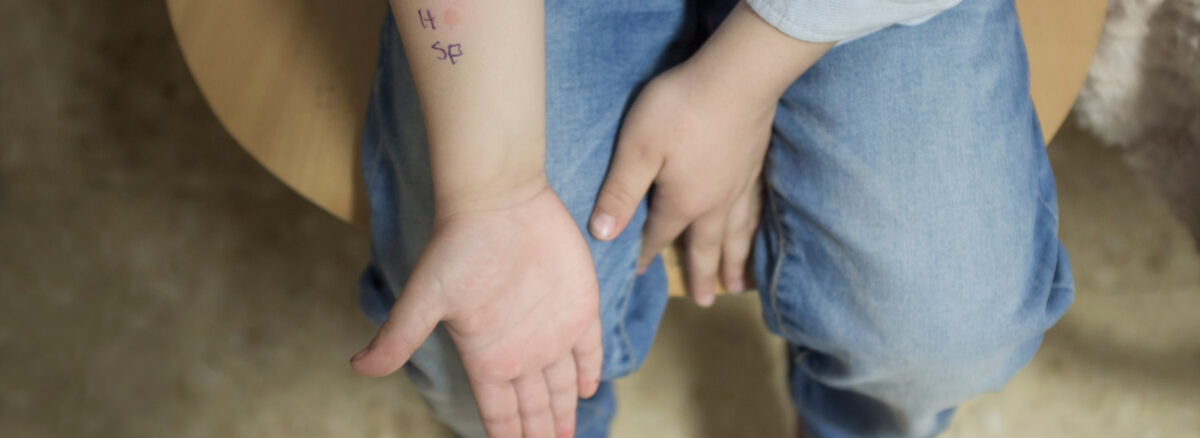 Skin Prick Tests
