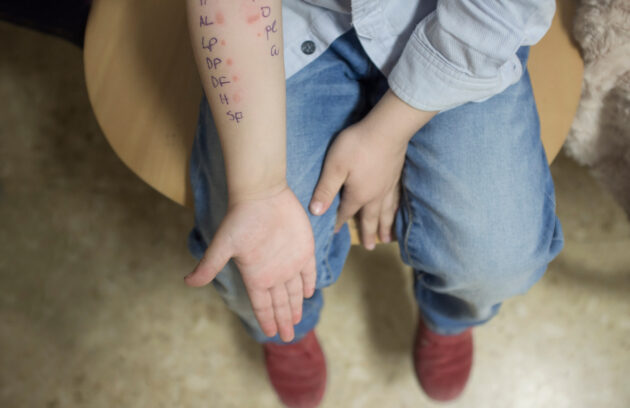 Skin Prick Tests