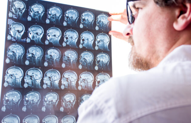 Pituitary Tumors
