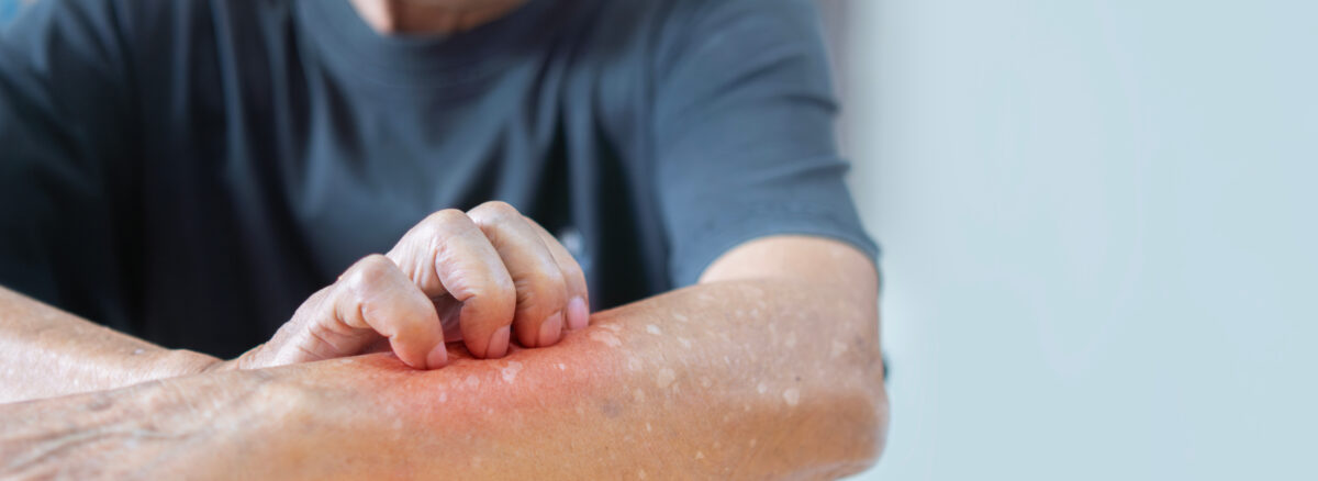 Drug Allergies: Allergic reactions to medications.
