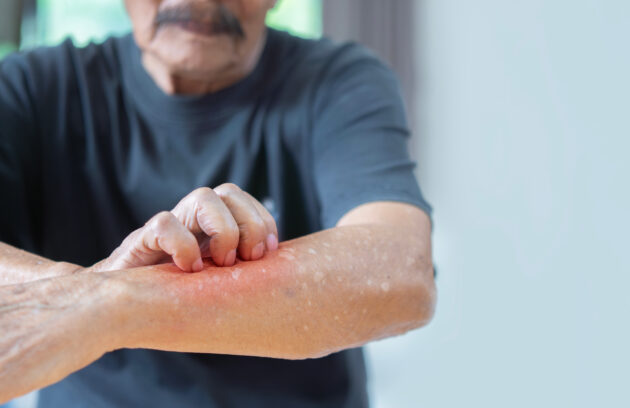 Drug Allergies: Allergic reactions to medications.