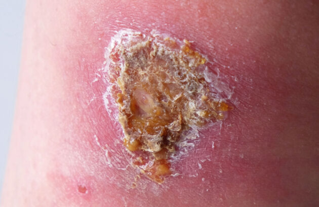 Signs of an Infected Wound