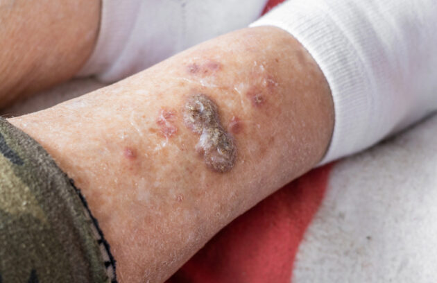 Acute vs. Chronic Wounds