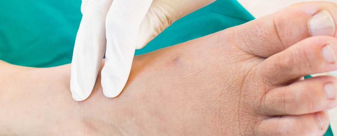 Charcot Foot
