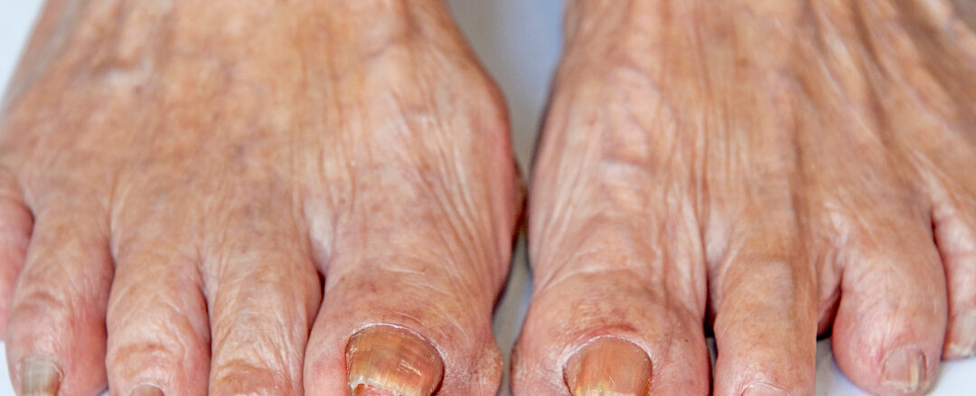 Toenail Abnormalities