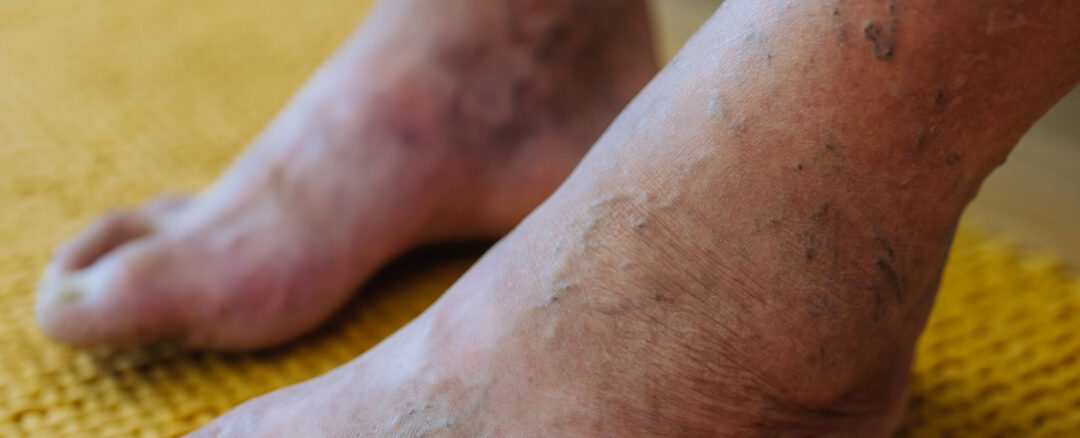 Managing Complex Peripheral Artery Disease in Diabetic Patients