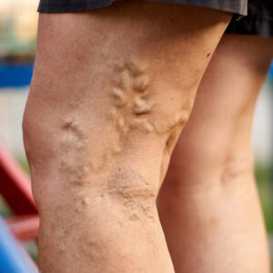 Personalized Anticoagulation Strategies in Patients with Venous Thromboembolism: Outline