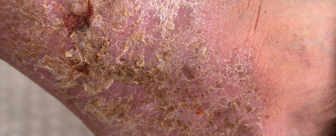 What Are Chronic Wounds and How Are They Treated?