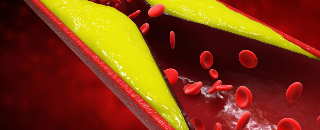 How to Prevent Blood Clots When Traveling Long Distances