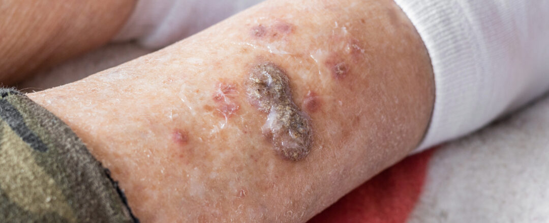 Understanding Pressure Ulcers: Prevention and Treatment