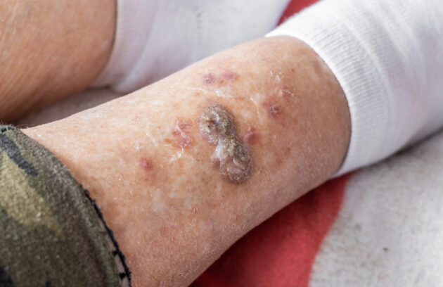 Understanding Pressure Ulcers: Prevention and Treatment